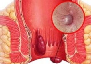 How is hemorrhoids